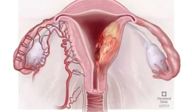 Endometrium Kanseri: Risk Faktörleri, Tanı ve Tedavi Yöntemleri