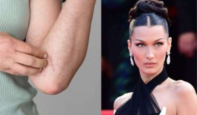 Bella Hadid’in Lyme Hastalığı ile Mücadelesi ve Bilgiler