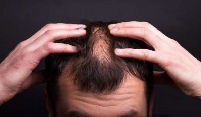 Noktasal Kellik (Alopecia Areata): Belirtileri ve Tedavi Yöntemleri