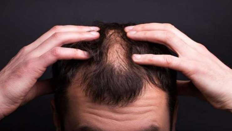 Noktasal Kellik (Alopecia Areata) Nedir? Belirtileri ve Tedavi Yöntemleri